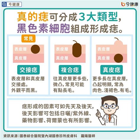 痣 凸起|是痣or皮膚癌？醫「1張圖秒對照」 長這2部位最危險